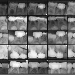 Biomateriali utilizzati nella pulpotomia di molari decidui messi a confronto: vantaggi e svantaggi