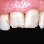 Dente naturale e implanto-protesi a confronto