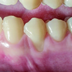 Trattamento di una recessione gengivale con matrice xenogenica