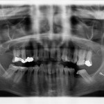 Perchè realizzare l’ortopantomografia direttamente nel proprio studio odontoiatrico studio odontoiatrico recupero-chirurgico-di-una-minivite-ortodontica-pavimento-orale