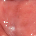 La leucoplachia del cavo orale: un caso clinico