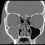 Aspetti biologici e clinici delle sinusiti odontogene