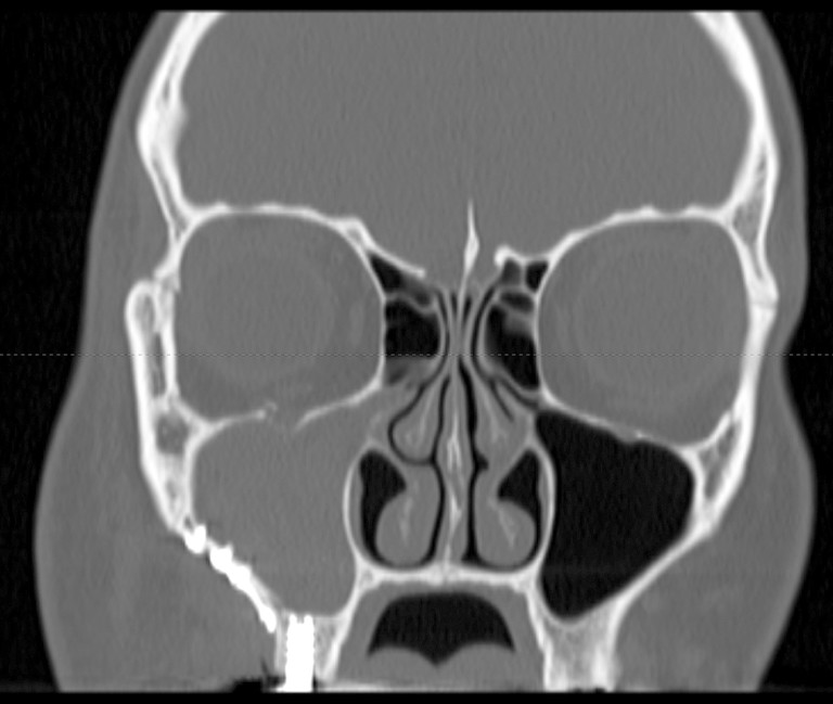 Aspetti biologici e clinici delle sinusiti odontogene