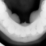 Esostosi e tori maxillo-mandibolari: revisione della letteratura e considerazioni cliniche