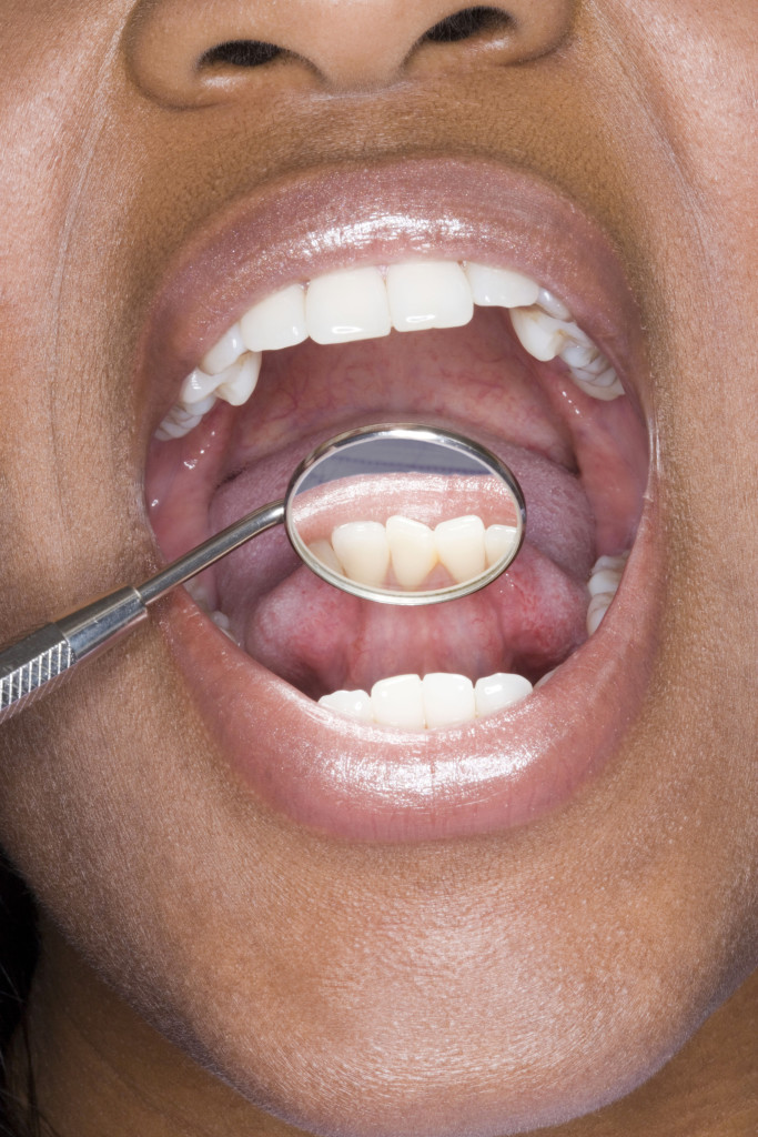 faccette in ceramica minimamente invasiva