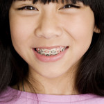 Prevenire la carie attraverso i programmi scolastici di sigillatura: raccomandazioni aggiornate e revisioni dell’evidenza