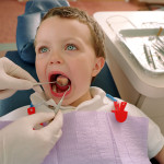 I sigillanti per prevenire la carie nei bambini carie nei bambini dentista