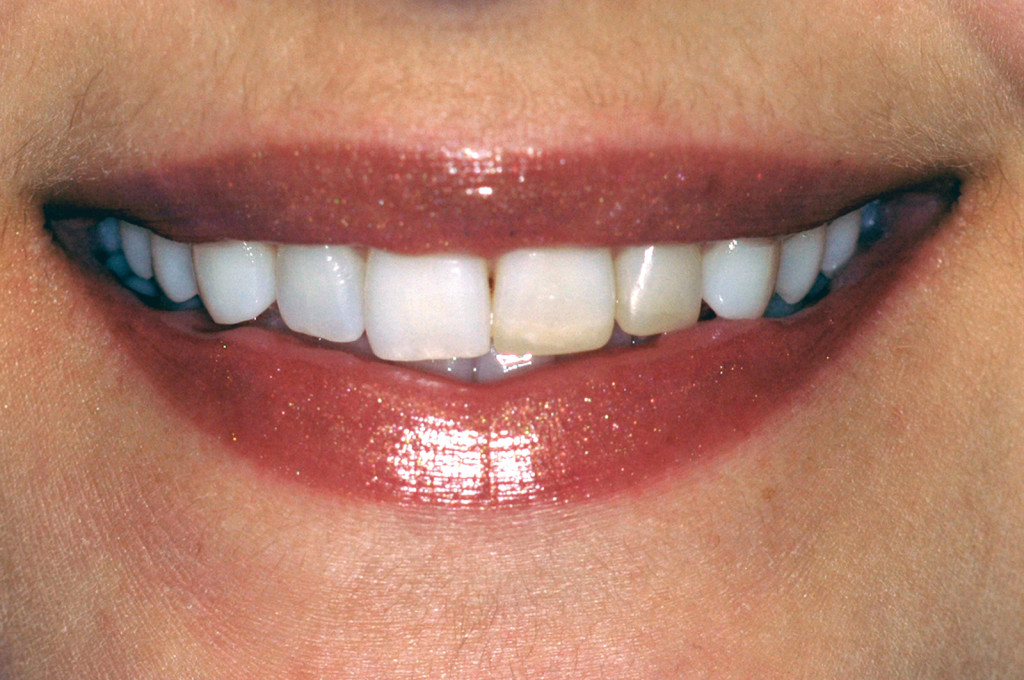 Ricostruzioni composito