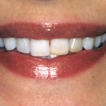 Longevità delle ricostruzioni dirette in composito Ricostruzioni composito