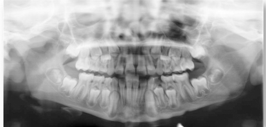 Sindrome di Noonan: presentazione di un caso