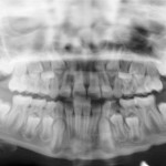 Sindrome di Noonan: presentazione di un caso Sindrome di Noonan: presentazione di un caso