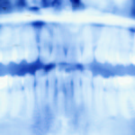 L’incappucciamento diretto con MTA: uno studio osservazionale