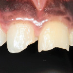 Traumatologia dentale: una soluzione adesiva diretta per i settori anteriori