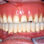 Riabilitazione di arcata superiore edentula mediante overdenture a supporto implantare. Utilizzo di attacchi a basso profilo ad ancoraggio di una barra