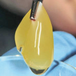 Effetto dell’uso del plasma ricco di fattori di crescita (PRGF) sulla qualità della vita di pazienti sottoposti a chirurgia endodontica in caso di perforazione della membrana del seno mascellare