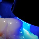 Le forze su intarsi inlay e onlay, in denti vitali e devitalizzati