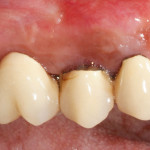 La gestione del carico immediato tramite l’utilizzo di abutment in poliossimetilene: risultati clinici e radiologici a due anni