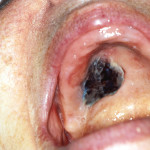 Melanoma nodulare primitivo della cavità orale. Caso clinico di diagnosi e terapia chirurgica Melanoma nodulare primitivo della cavità orale