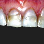 Trattamento combinato parodontale e restaurativo per la riabilitazione del settore anteriore