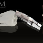 Risultati della terapia implantare nel paziente con storia di parodontite grave estrusione ortodontica preimplantare lesioni periapicali, impianti dentali, gestione dei tessuti molli perimplantari impianto dentale e dente, perimplantite