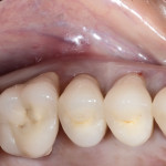 Preservazione dell’estetica in paziente esigente: impianto post-estrattivo a carico differito, case report