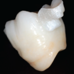 Dall’oro-ceramica allo zirconio nell’era della cad-cam