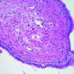 Le cisti del mascellare superiore: diagnosi differenziale tra cisti odontogene e non odontogene