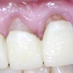 Trattamento chirurgico-protesico di una zona ad alta valenza estetica