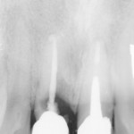 Riabilitazione di due incisivi centrali con impianti bone level e corone in zirconia