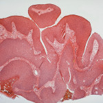 Infezione da HPV delle mucose orali: rapporto di un caso clinico e ruolo dell’odontoiatra nella prevenzione del carcinoma del cavo orale