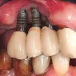 Ricostruzione tridimensionale di un grave difetto mediante rigenerazione ossea guidata (GBR)