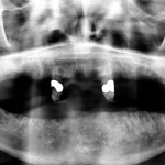 Riabilitazione implantare dopo exeresi di cancro orale in pazienti radiotrattati: follow-up a 5 anni