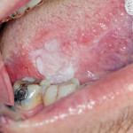 Il laser a diodi nel trattamento dei tessuti molli del cavo orale: uno studio retrospettivo per valutare il danno fisico e istopatologico indotto