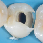 Influenza della lunghezza del perno in fibra sulla resistenza alla frattura di premolari trattati endodonticamente e restaurati con tecniche adesive dirette