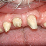 Pianificazione razionale nelle grandi riabilitazioni con impianti post-estrattivi immediati