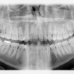 Anestesia locale in odontoiatria infantile