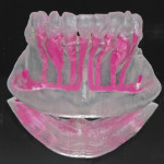 Alterazioni neurosensoriali conseguenti a prelievo osseo da sinfisi mentoniera