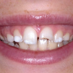 Restauro conservativo diretto di un incisivo centrale fratturato