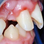 Chirurgia orale pediatrica: associazione tra odontoma, fusione dentale e mesiodens