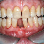 Riabilitazione di un incisivo mandibolare per mezzo di un ponte adesivo in zirconia. Caso clinico