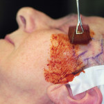 Lipoma facciale. Un caso clinico