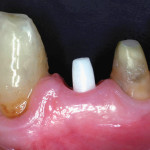 Utilizzo del Pink Esthetic Score nella valutazione dei tessuti molli attorno a impianti monocomponenti in zirconio: studio clinico preliminare