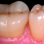 L’overlay in composito per il restauro dei denti posteriori trattati endodonticamente. Un caso clinico