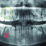 Indicazioni cliniche per l’autotrapianto di premolari: protocollo per denti immaturi