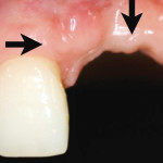 Design organico applicato ai restauri implanto-protesici