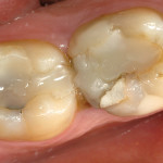 Trattamento con metodica CAD/CAM di un elemento diatorico
