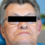 Riabilitazione protesica in un soggetto con notevole atrofia del mascellare inferiore