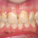 La gestione estetica e clinica delle ipoplasie dello smalto del settore frontale mediante tecniche conservative dirette