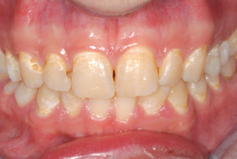 Displasia ectodernica e complicanze odontoiatriche