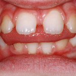 Esercizi semplificati in terapia miofunzionale: presentazione di un protocollo terapeutico